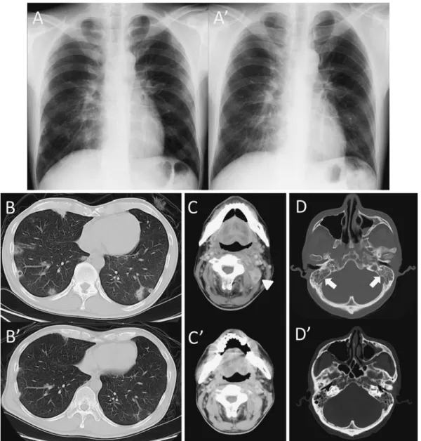 Fig. 2 Chest radiography on admission showed multiple nodules (A). Chest CT (B) demonstrated   bilateral multiple pulmonary nodules and cavities. (C) Axial CT slice of the third cervical verte- bra showed a mass lesion (arrow head). (D) Acute mastoiditis i