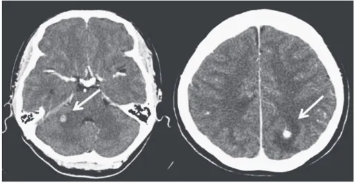 Fig. 2 Left  lower  limb  echography  showing  a  cal- cal-cified nodular lesion (white arrow).