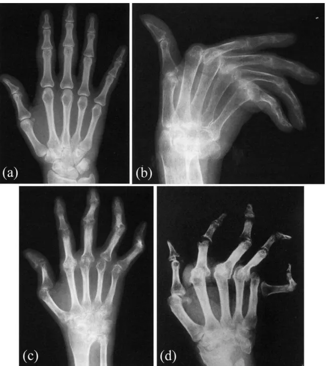 Figure 5. Typical X-ray absorption contrast images of the hands of patients  suffering from rheumatoid arthritis in (a): early stages and (b)-(d):  advanced stages