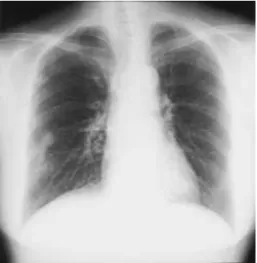 Fig. 1a Chest radiograph of case 1 shows multiple nodular shadows in both lung fields.