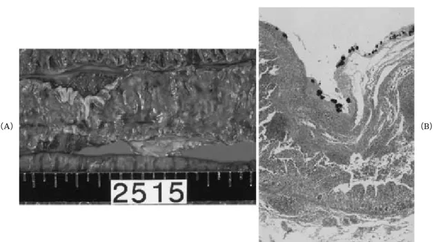 Fig . 3 （ A ）Macroscopic appearance of pseudomembranous enteritis . Scattered plaques are seen.（B）Microscopic specimen showing pseudomembranous enteritis.