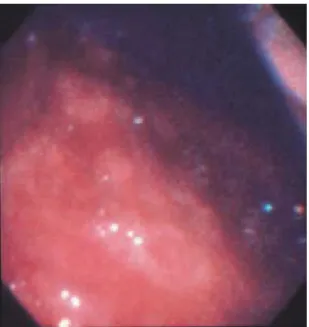 Fig. 5 A histological image of the pleural biopsy tis- tis-sues. Granuloma formation presenting palisade.