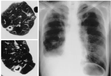 Fig. 1 Chest X-ray film &amp; CT scan on admission showed diffuse nodular shadows in the bilateral lung fields and multiple cavity formations with thick wall in the right upper and lower lung fields.