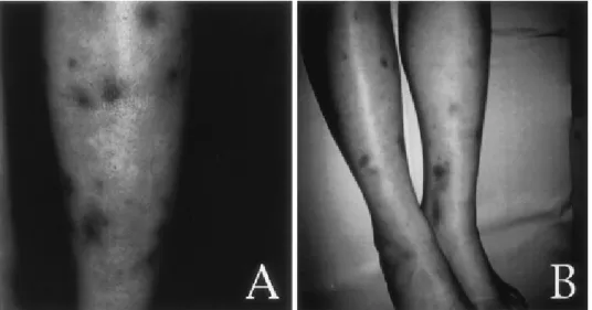 Fig. 2 Chest roentogenography.（A）Apparent abnormal shadow（acino-nodosa pat- pat-tern）is seen in left apex.（B）Abnormal shadow is almost adsorbed after  anti-tuberculous therapy.