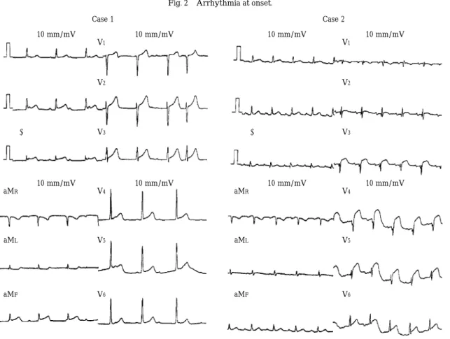 Fig. 2 Arrhythmia at onset.