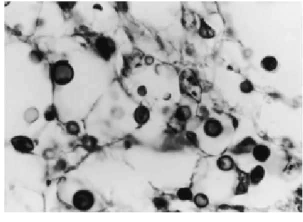 Fig. 1 Cryptococcal bodies seen in the meninx（PAS stain, ×400）.
