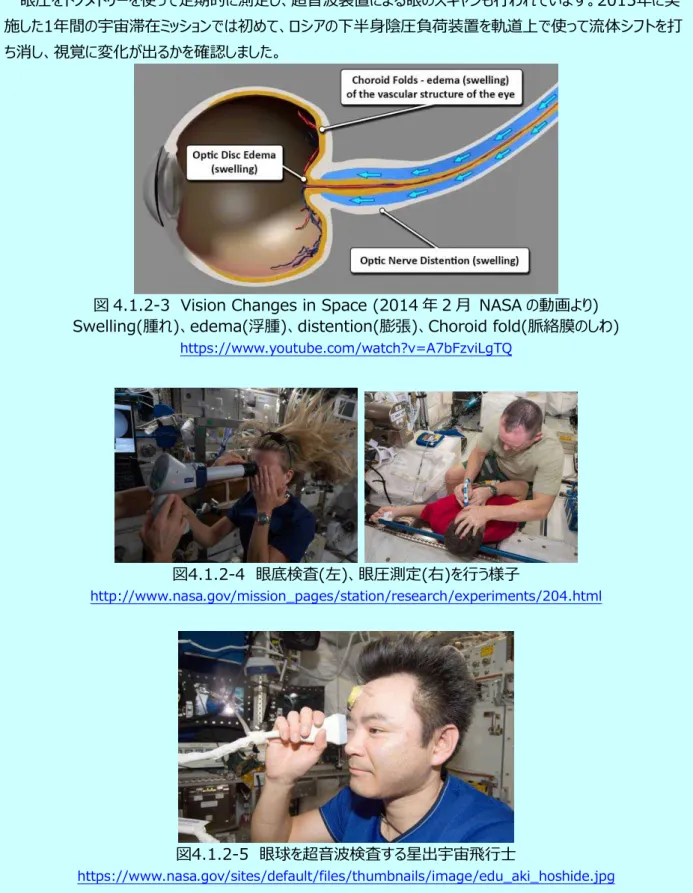 図 4.1.2-3  Vision Changes in Space (2014 年 2 月  NASA の動画より)  Swelling(腫れ)、edema(浮腫)、distention(膨張)、Choroid fold(脈絡膜のしわ)  https://www.youtube.com/watch?v=A7bFzviLgTQ  図4.1.2-4  眼底検査(左)、眼圧測定(右)を行う様子  http://www.nasa.gov/mission_pages/station/research/experim