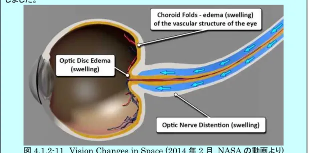 図 4.1.2-11  Vision Changes in Space (2014 年 2 月  NASA の動画より)  Swelling(腫れ)、edema(浮腫)、distention(膨張)、Choroid fold(脈絡膜のしわ) 