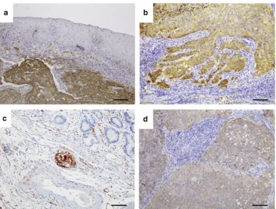 FIG. 1 Representative photomicrographs of tissue sections immunostained for CD36 expression: a High CD36 expression was observed in a representative ESCC section