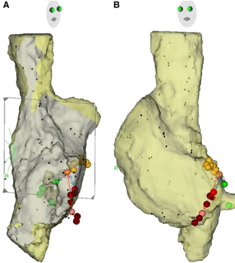 Fig. 1 Right atrial endocardial electroanatomic mapping superimposed on computed tomographic images in the right (a) and left (b) oblique projections