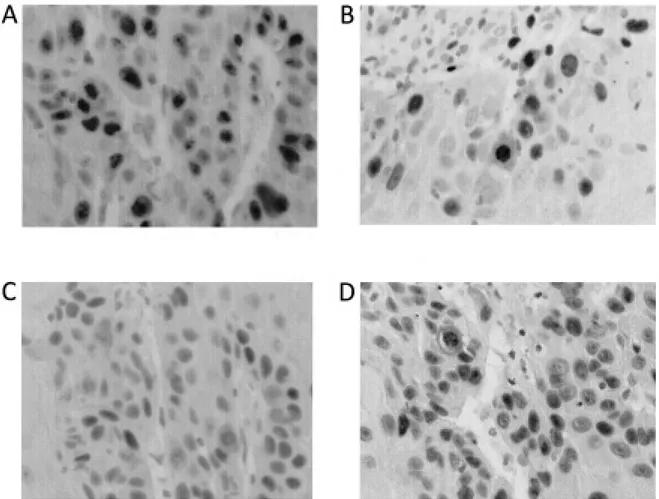 Fig. 2 Results of the immunohistochemical staining with Ki ‑ 67 (A), Topo II α (B), p53 (C), and p63 (D) in a representative case (Patient no