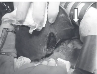 Fig. 1.   Aberrant bile duct (arrow) was present between the left edge of the left triangular ligament and inferior surface of the  lateral segment, and was ligated and isolated for mobilization of the lateral segment of the liver.