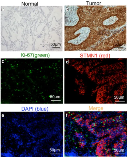 FIG. 1 Immunohistochemical analysis of STMN1 in surgical specimens. Representative immunohistochemical staining of STMN1 in a normal tissue and b cancer tissue of the same case (magnification 9200)