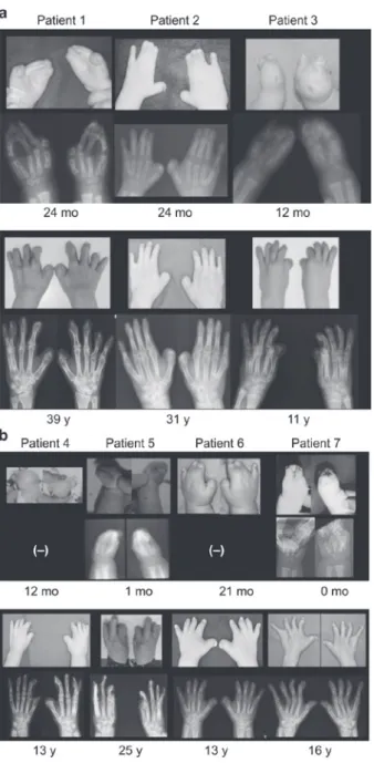 Table 2. 　 Total active range of motion in degrees Digits of the right hand Digits of the left hand