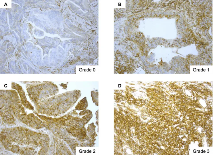 Figure 1 shows HLA class I expression by rectal tumor cells.