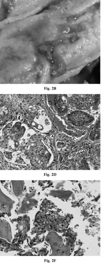Fig. 2A   Fig. 2B   Fig. 2C   Fig. 2D   Fig. 2F Fig. 2E   Fig. 2 Pathology of the stomach and spine tissues obtained at autopsy 2A : Macroscopic appearance of the stomach obtained at autopsy,which was suggestive of occult change of cancer. 