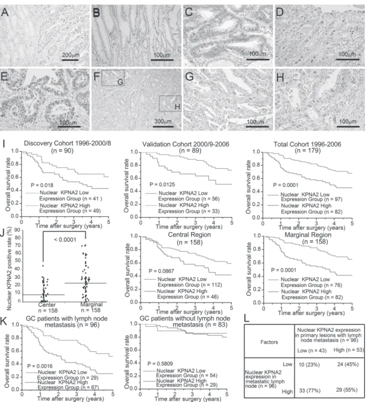 Fig. 1.  Immunohistochemical staining of nuclear KPNA2 in primary GC. (A) Nuclear KPNA2 expression in GC and normal gastric mucosa (×20 magnification)