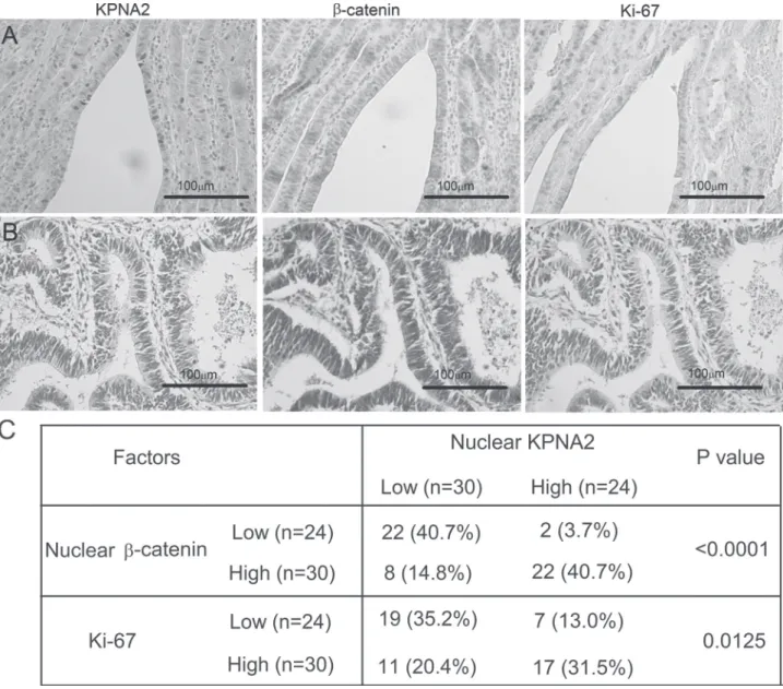 Figure 1K). In that same group of 96 patients, 33 of 43 (77%) patients,  who showed low expression of nuclear KPNA2 in the primary lesion,  had high expression of KPNA2 in the metastatic lymph nodes  (Figure 1L).