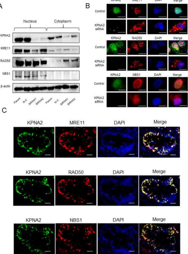 Figure 4: Karyopherin-α2 (KPNA2) and MRE11-RAD50-NBS1 (MRN) complex expression in cholangiocarcinoma  cell lines and tissues