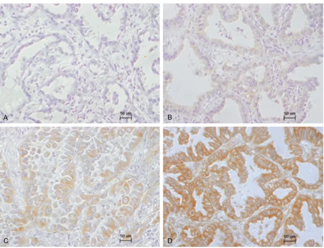 Figure 2. Representative immunohistochemical staining pattern of aromatase in lung adenocarcinoma