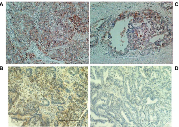 Figure  2. Scoring  of  CD98  expression  in  GC  tumor  sections.  CD98 scores of 1, 2, 3, and 4 were observed in 80%, 12%, 7%, and 1% of GC tumor sections, respectively.