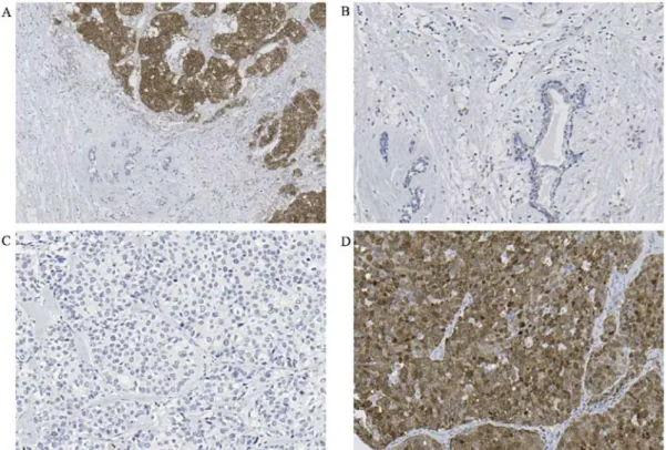 Figure 1. Immunohistochemical analysis of STMN1 expression in a representative breast cancer tissue and normal tissue samples