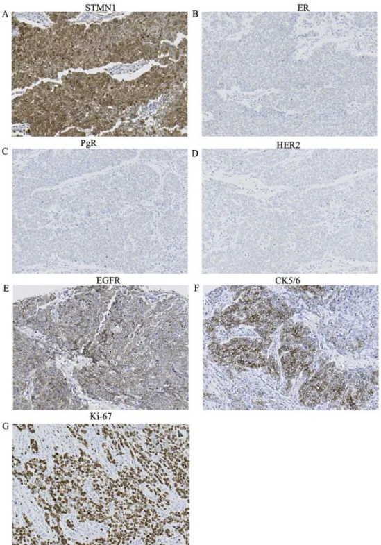 Figure 2. Immunohistochemical analysis of STMN1, ER, PgR, HER2, EGFR, CK5/6 and Ki-67 expression in the representative breast cancer tissue from a  patient