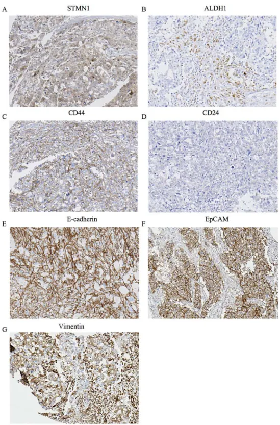 Figure 3. Immunohistochemical analysis of STMN1, ALDH1, CD44, CD24, E-cadherin, EpCAM and vimentin expression in a representative breast cancer  tissue from a patient