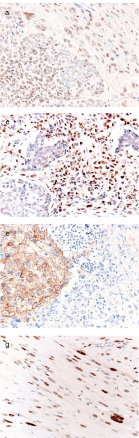 Figure 2 Immunohistochemistry for epithelial-mesenchymal  transition-asso-ciated transcription factors and p53