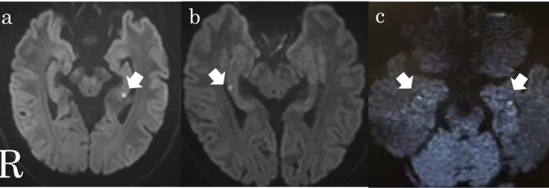 Fig. 1 頭部 MRI 拡散強調画像での病変部位の左右差 