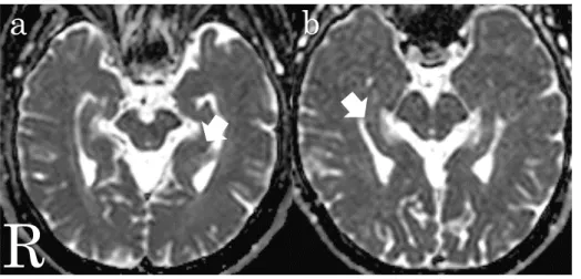 Fig. 2 頭部 MRI 拡散強調画像での ADC 値の低下 