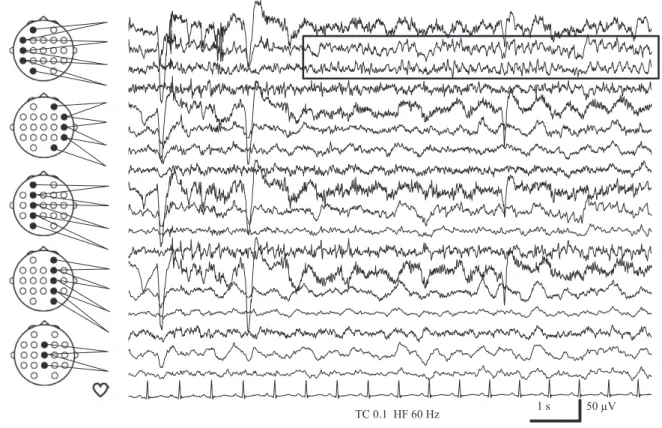 Fig. 2 Ictal EEG findings of long-term video EEG monitoring.