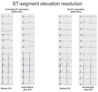 Fig. 1.  ST - segment elevation resolution