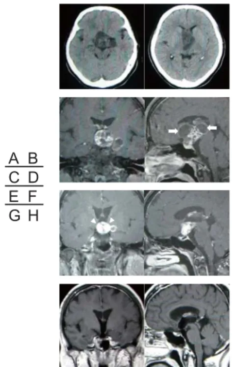 Fig. 1.   Preoperative computed tomography scans showing a  cystic mass extending from the suprasellar region to  the third ventricle