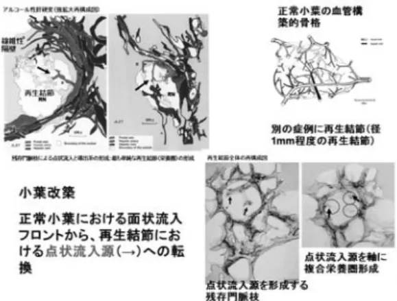 Fig. 3.    Three-dimensional reconstruction of an angioarchitecture  of regenerative modules in two cases with alcoholic liver  cirrhosis
