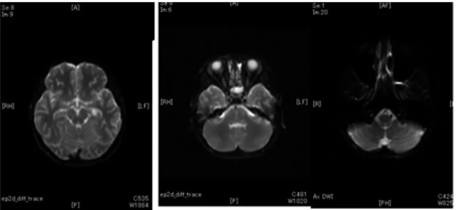 Fig.  2 . 　第 13 病日の MRI T 2  ﬂair （大脳）