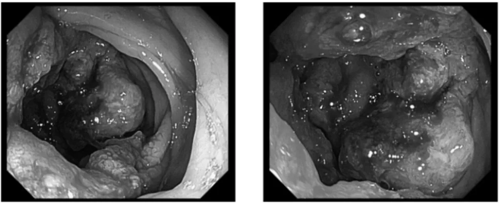 Fig. 1 下部消化管内視鏡所見 上行結腸に 2型の全周性の腫瘍を認め生検の結果 Group Ⅴ, 高〜中分化管状腺癌と診断された. Fig. 2 初診時腹部 CT 検査 a: 上行結腸に不均一な造影効果を示す腫瘤 ( 矢印 ) を認める 