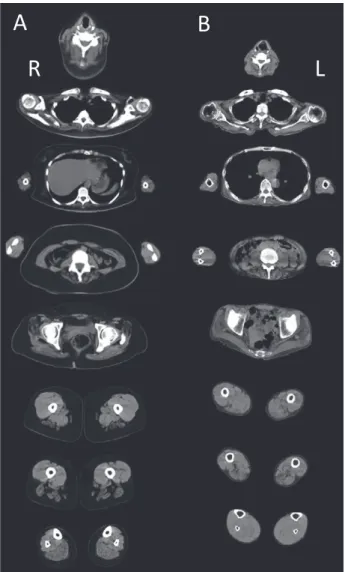 Fig. 1 Pictures taken before (A) and after (B) treatment in Case 1. The patient had lordosis and camptocormia (A), which improved   after one year of treatment (B).