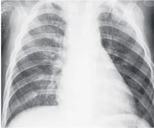 Fig. 5　Chest X-ray ﬁlm on admission. Chest X-ray ﬁlm  shows a slight diffuse nodular shadow.