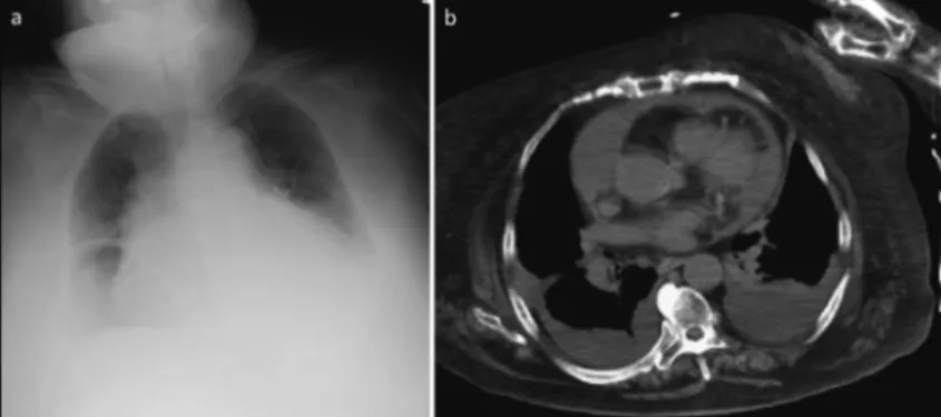 Fig. 1 Chest X-ray film and computed tomography(CT) image at arrival.