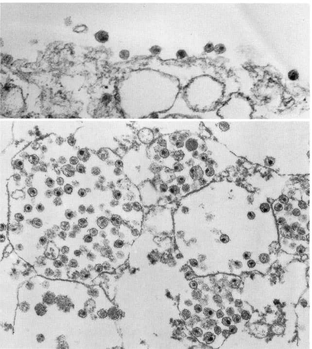 Fig.  2  Transmission  electron  micrographs  of  HIV  isolated  from  patient  with ARC
