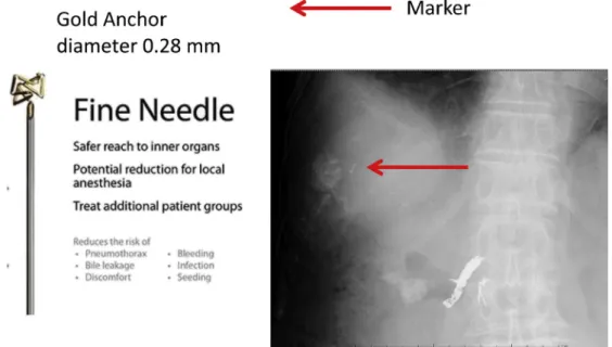 Fig. 1 e Radiograph after insertion. Characteristics of the iron-containing Gold Anchor fiducial marker, which can be placed spherically with a thin 22G or 25G needle
