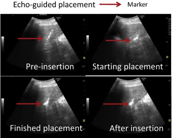 Fig. 2 e Echo-guided placement. Use of a 22G needle in echo-guided placement of the GA in the liver