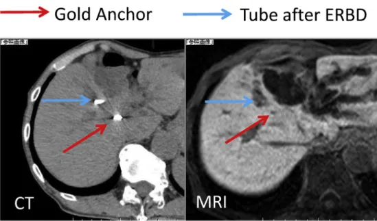 Fig. 6 e After placement CT and MR images. Planning CT and hepatobiliary phase MRI, recognition of a marker is good in both images and registration was easily performed