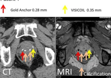 Figure 5.  Gold  Anchor:  A  red  arrow.  The  artifacts  on  CT  was  bigger than VISICOIL