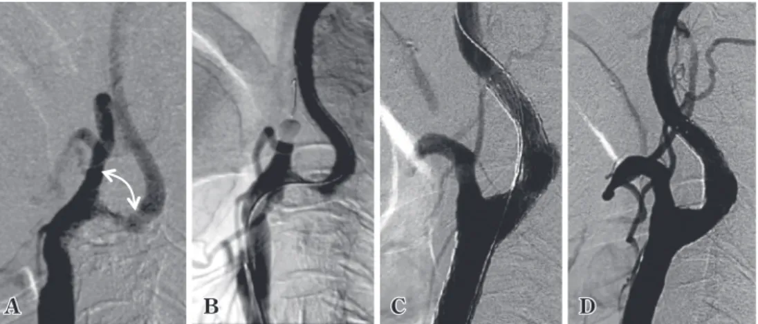 Table 2  Risk factors associated with stroke in  the EVA 3S trial
