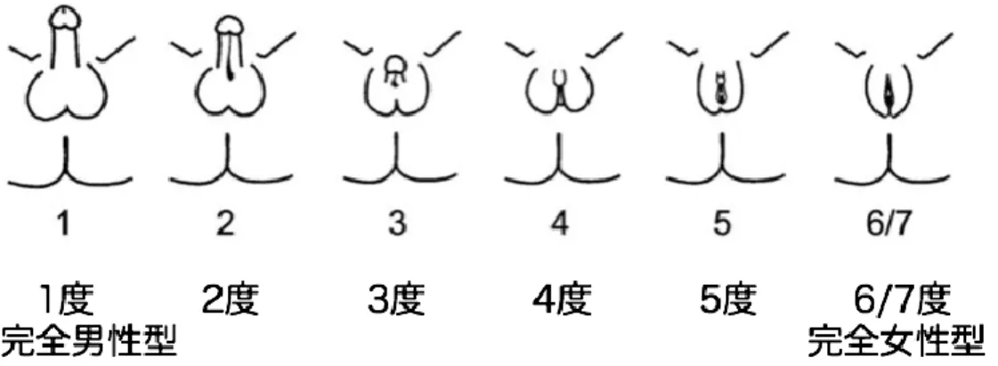 図 2  Quigley 分類（恥毛発育ありが 6 度、恥毛発育なしが 7 度）  表 1  性分化疾患を疑った場合の評価項目と方法  性別  器官  項目  方法  男性  陰茎  伸展陰茎長の計測  メジャー  尿道口開口部の確認  視診  腹面屈曲の有無  視診  包皮の分布異常（背側 v.s