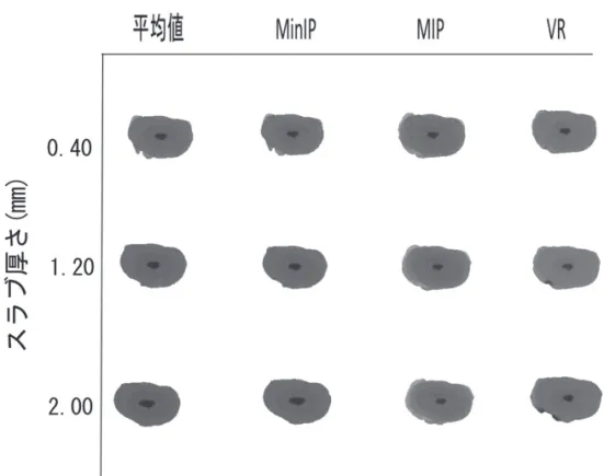 図 7 　抜去歯（No.14）の歯軸位断面像