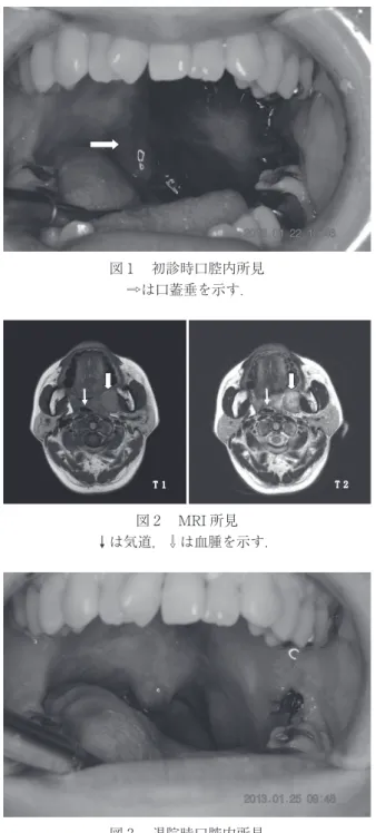 図 MRI 所見 は気道， は血腫を示す．