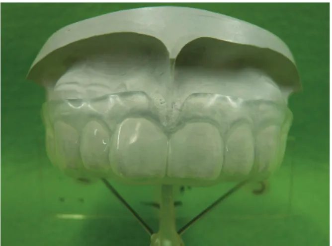 Fig． Three types of mouthguard（Thick lines show out- out-line of each mouthguards）.